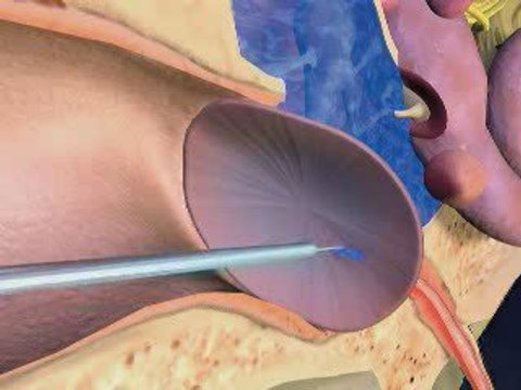 What Are Ear Tubes - Tympanostomy Sugery Video