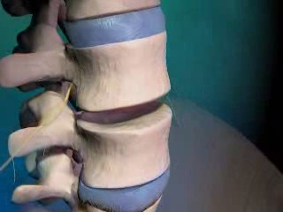 Degenerative Disc Replacement