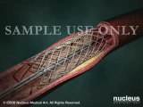 Coronary Artery Stent (Angioplasty Procedure) Detail