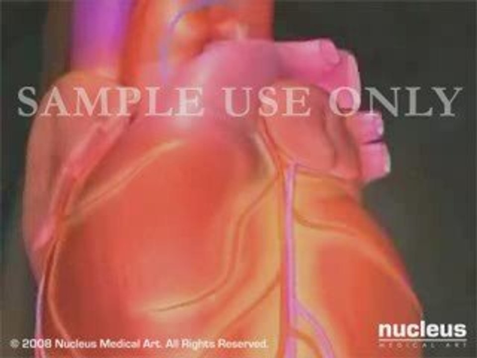Stent Angioplasty