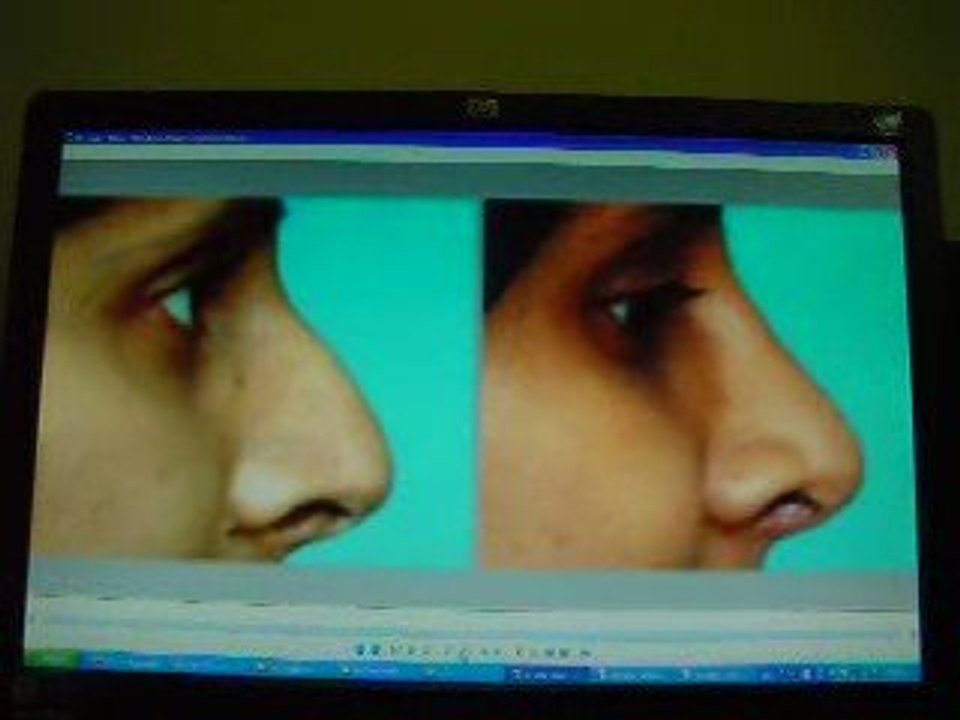 تجميل الانف-جراحة تجميل الانف