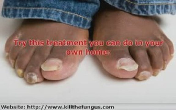 The best toenail fungus remedies and treatments.