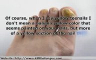 Have nasty yellow toenails caused from nail fungus? Try thes