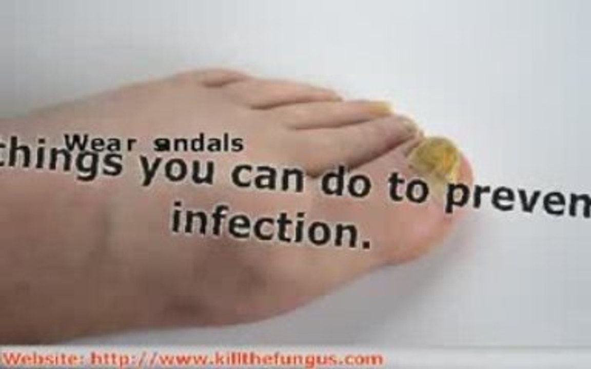 If you haveToenail Fungal Infection, here is How to Keep You