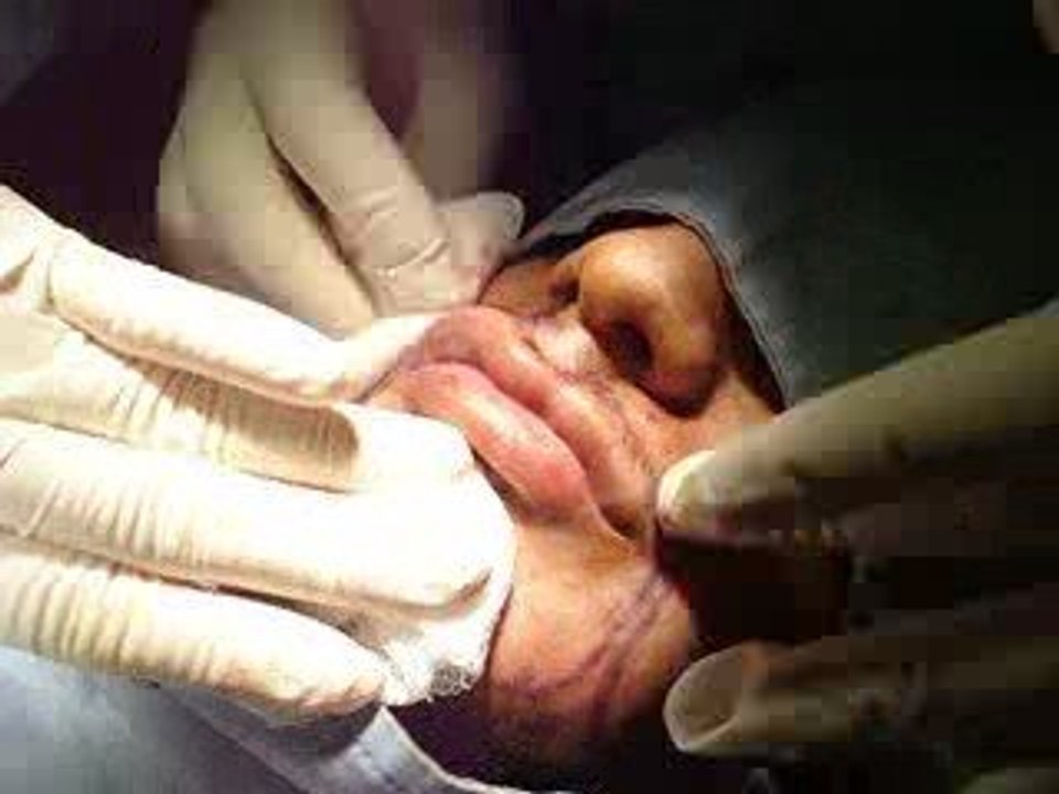 hair transplantation-qatar-dubai-زرع الشعر -دبي-قطر-عراق