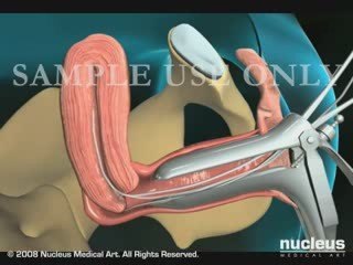 Endometrial Biopsy of the Uterus