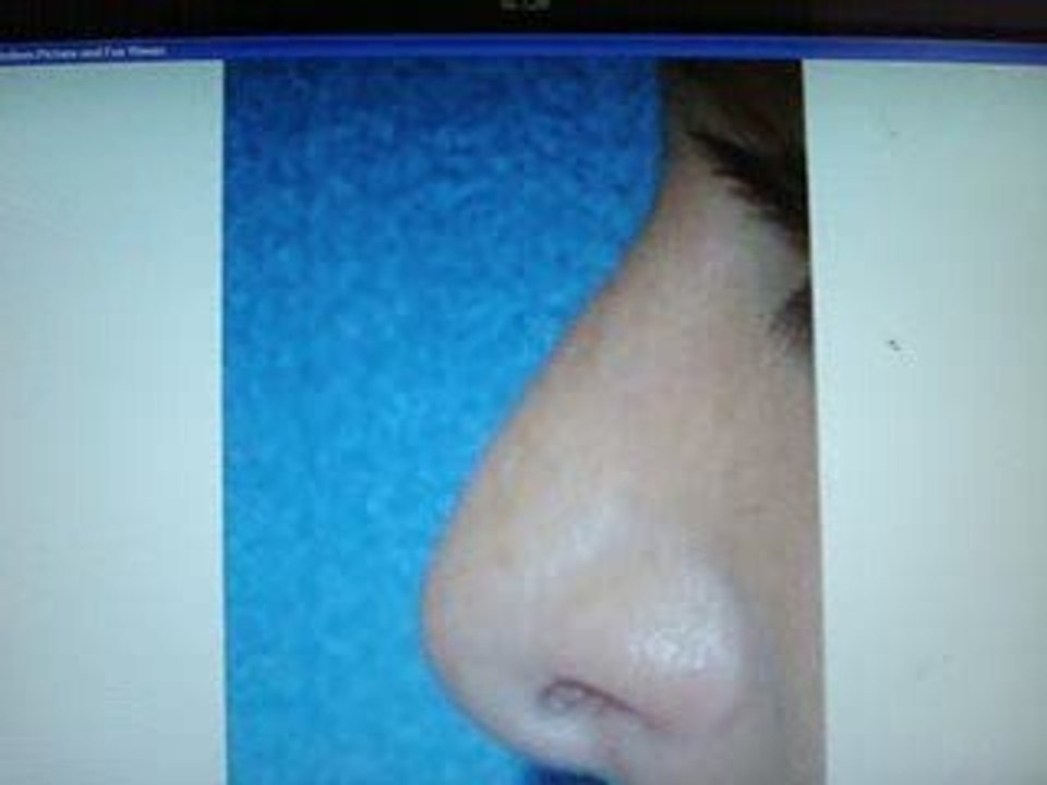 عمليات التجميل-الليزر-تجميل الانف- المنخار-زرع الشعر-قطر-دبي