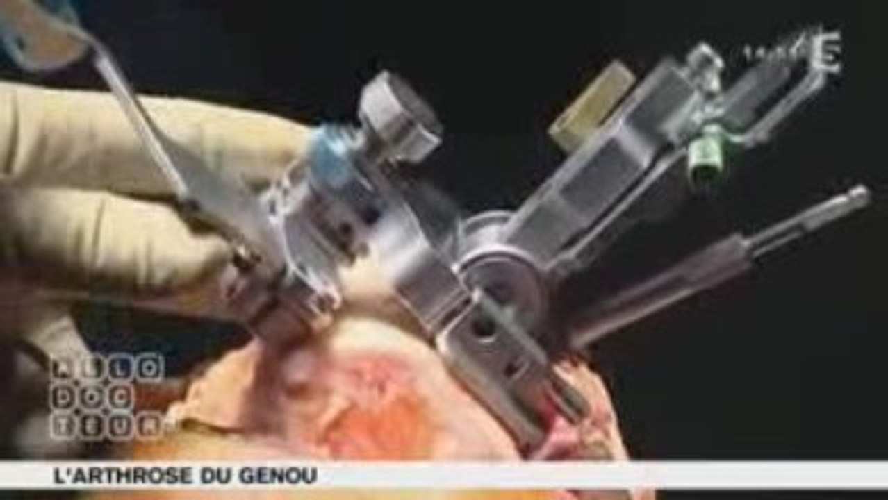 Arthrose du genoux Partie 2