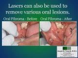 Laser Gum and Oral Surgery Options