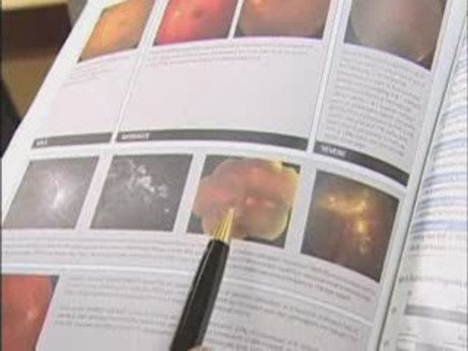 Santé de l’œil : rétinopathie diabétique