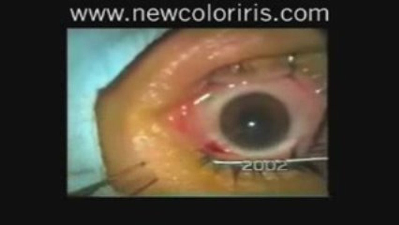 Permanently Change Eye Color-Dont Do It