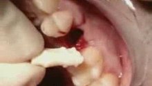 ZIRCONIA DENTAL IMPLANT