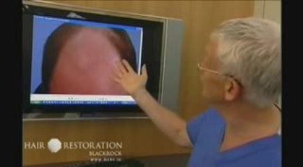 Dr. Maurice Collins from HRBR talks about Hair Loss - Part 2
