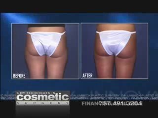 Dr. Galumbeck shows laser liposuction of the hips & thighs