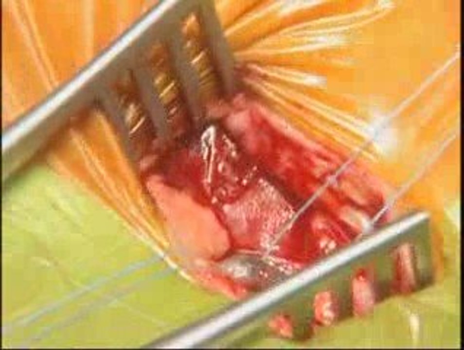 Implantation du stimulateur cardiaque REPLY DR