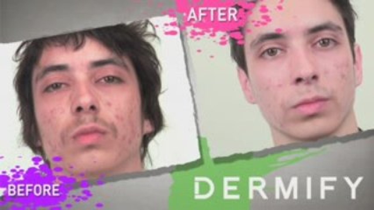Acne Ain't Cool... Dermify's Acne Treatment get...