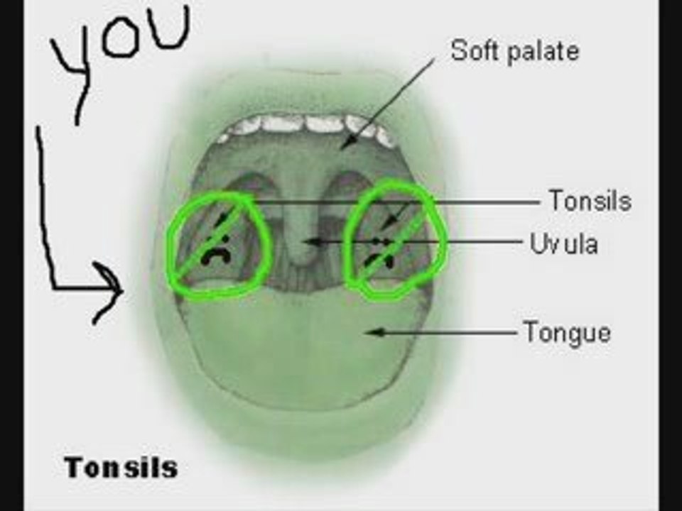 How do I know if I have tonsil stones?