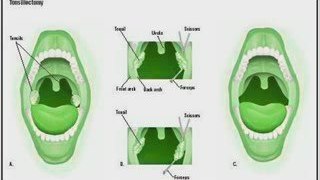 What are Tonsil, Stones?