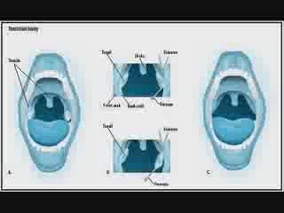 Tonsil Stones Treatments – Home Made Treatments