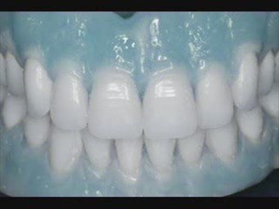 TMJ Care No Dental Implants or Uncomfortable Devices