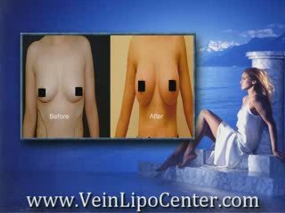 Breast Implants San Diego | Breast Implants San Diego