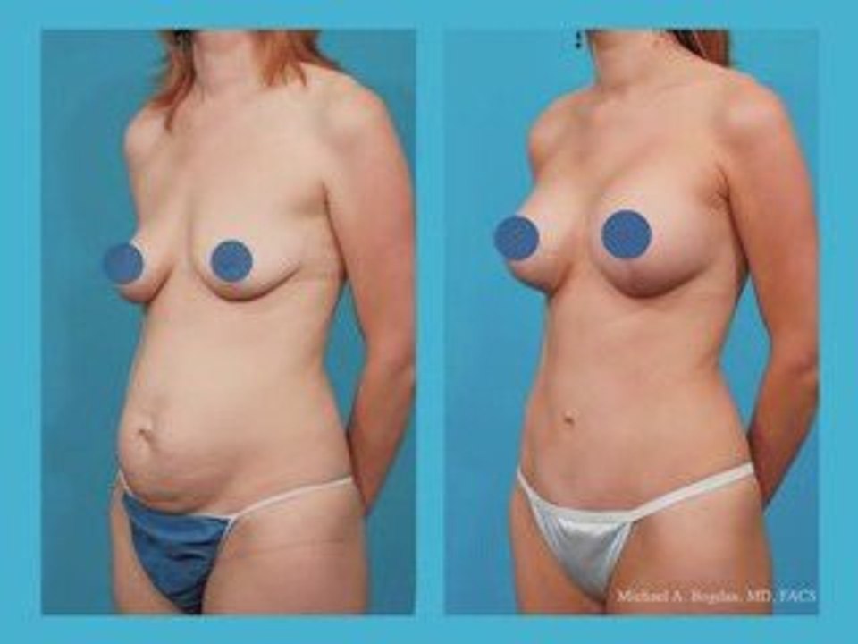 The "Mommy Makeover" procedure - Dr. Michael Bogdan