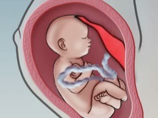 Pregnancy Risks -- Placental Abruption