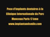 Pose d'implants dentaires paris www.implantandsmile.com