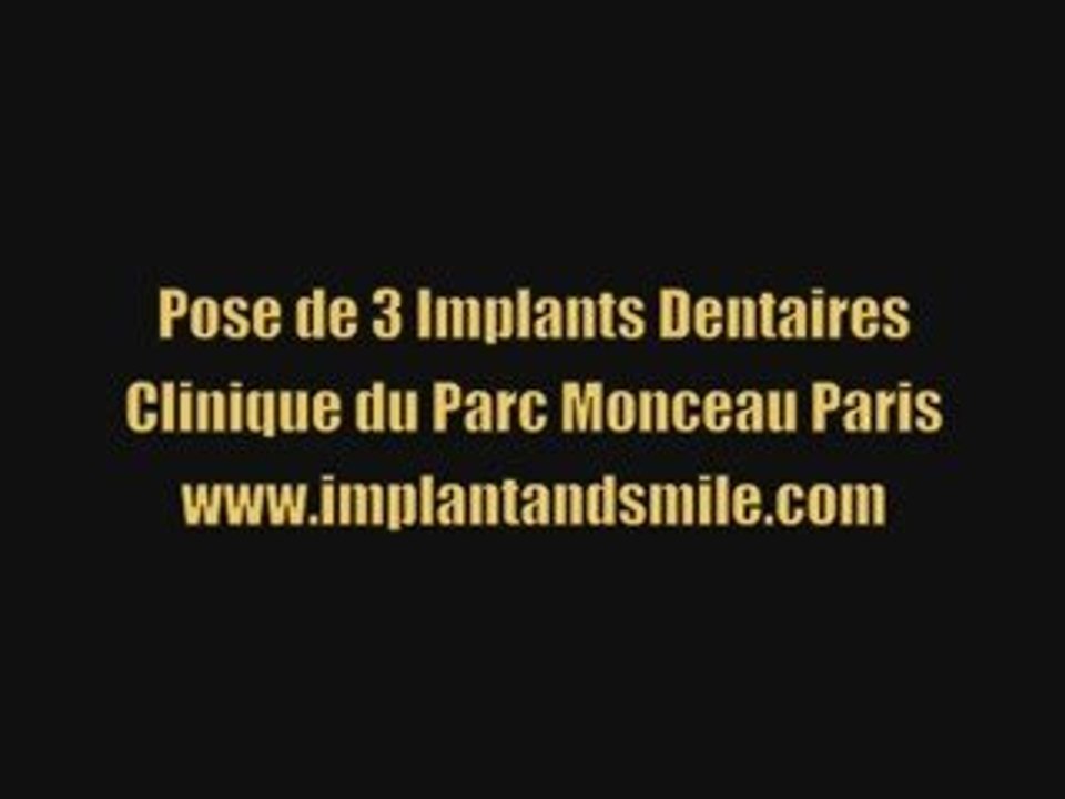 Pose de 3 implants dentaires Paris