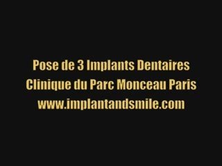 Pose de 3 implants dentaires Paris