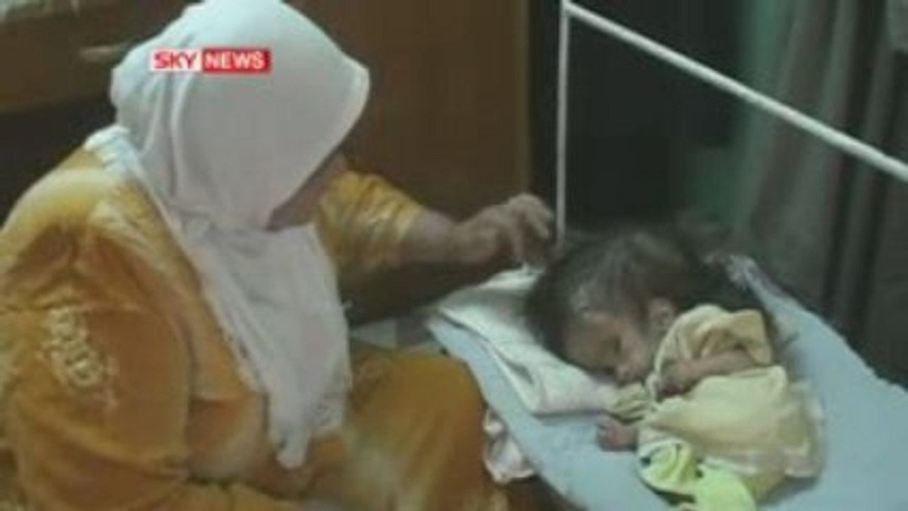 Fallujah depleted uranium deformed babies