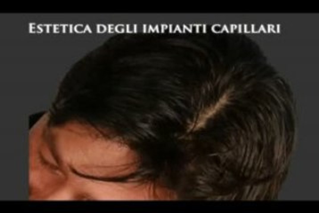 CALVIZIE   www.luigiuomo.com