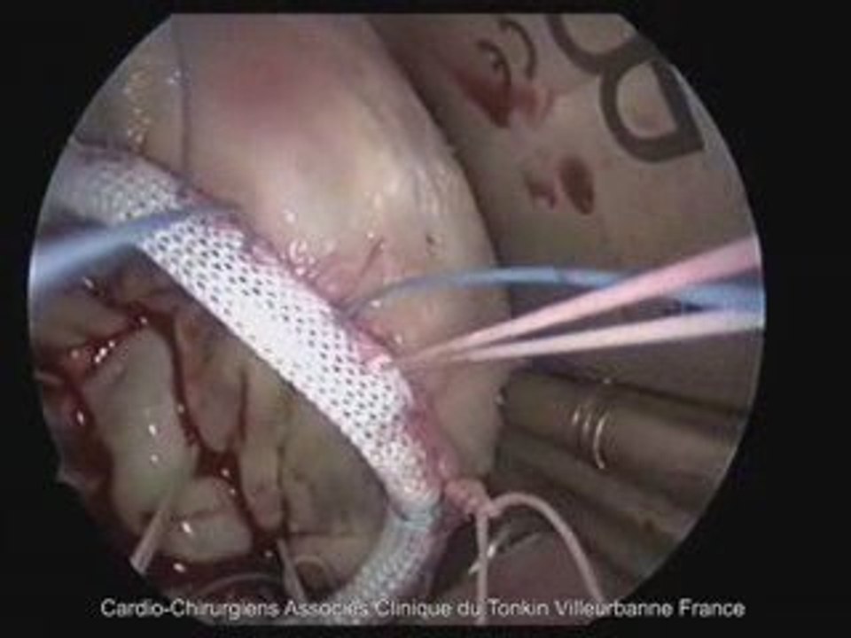 Plastie mitrale Goretex minimally invasive