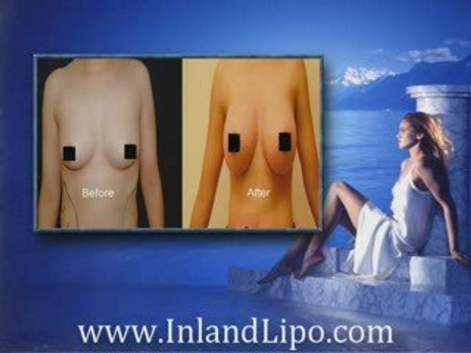 Temecula Breast Augmentation | Breast Augmentation Temecula