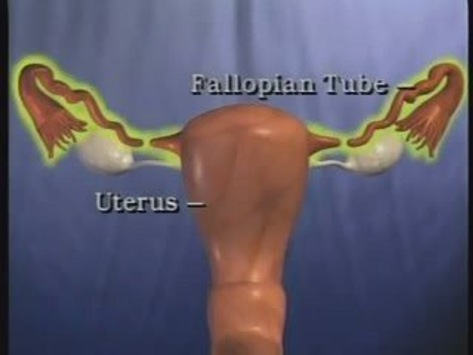 Tubes Tied - Tubal Reversal Video