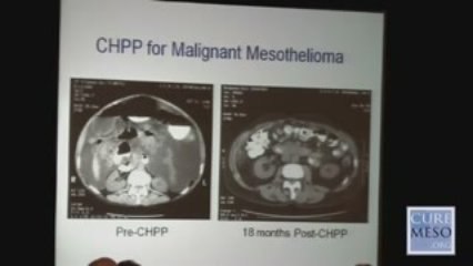 Peritoneal Mesothelioma
