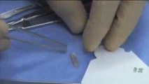 Reverse Tubal Ligation - Hulka Clips