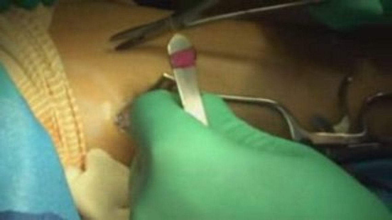 YouTube - Dr. Patrick DeHeer_ DPM - Gastroc Recession for Pe