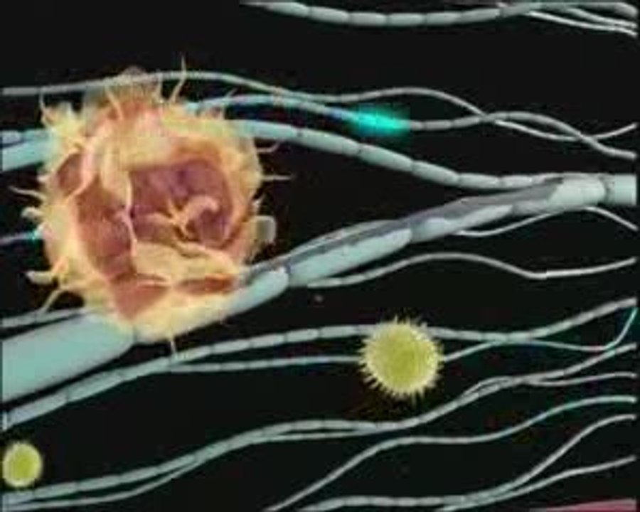 Esclerosis Multiple