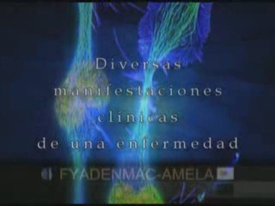 Esclerosis lateral amiotrofica: Generalidades