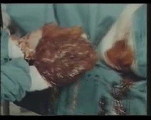 Poród kleszczowy i przy pomocy próżniociągu