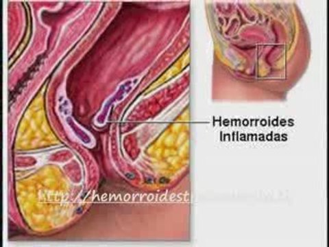 consejos aliviar dolor picazon sangrado y curar hemorroides