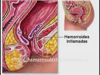 consejos aliviar dolor picazon sangrado y curar hemorroides