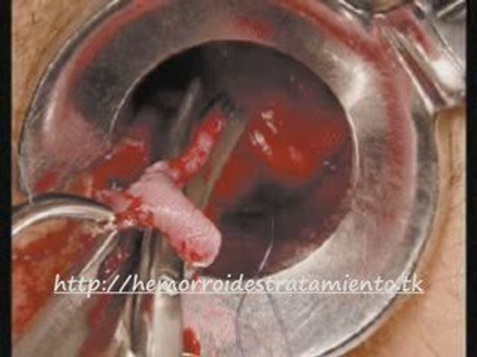 Hemorroides Internas y Externas: Sintomas y Tratamiento