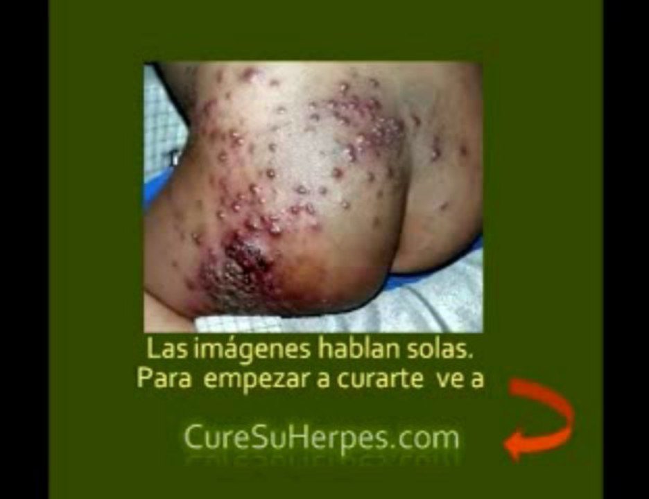 Herpes - Fotos - Como Curar lo y su Tratamiento