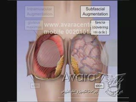 تكبير الارداف و شد المؤخرة