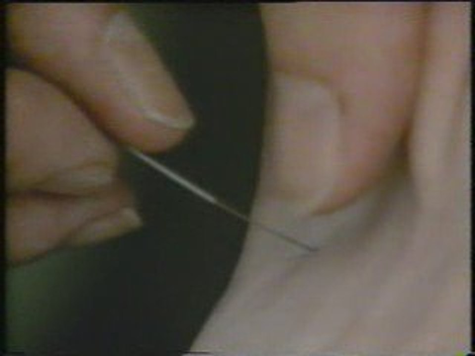 Acupuntura (1): Terapia alternativa