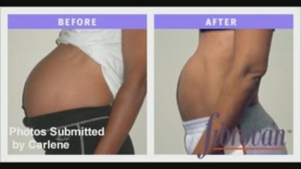 Alternative to Fibroid Surgery - There is a Better Way