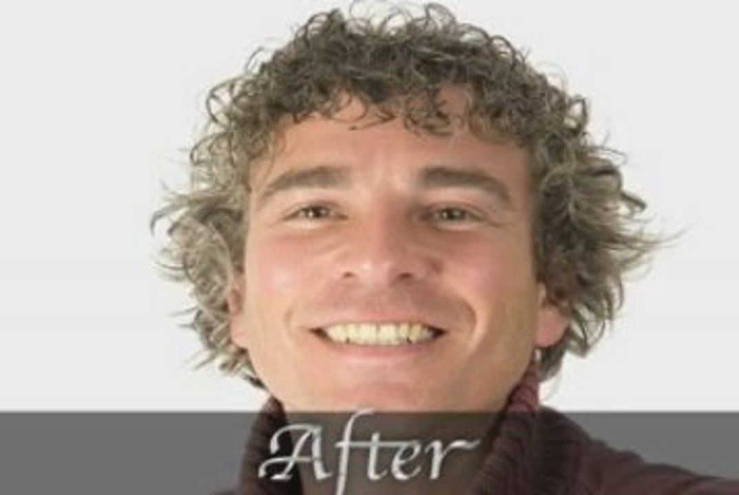 Hair Loss Replacement Orange County California