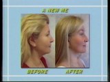 Washington DC Cheek Lift Surgery Patient Results Gallery